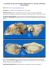 CARCINOMA DE CÉLULAS ESCAMOSAS ORIGINADO EN LA