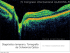 Diagnóstico temprano, Tomografía de Coherencia Óptica IV
