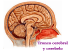 Tronco cerebral y cerebelo