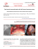 Total arterial revascularization with left internal mammary artery