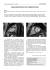 MIOCARDIOPATÍA NO COMPACTADA